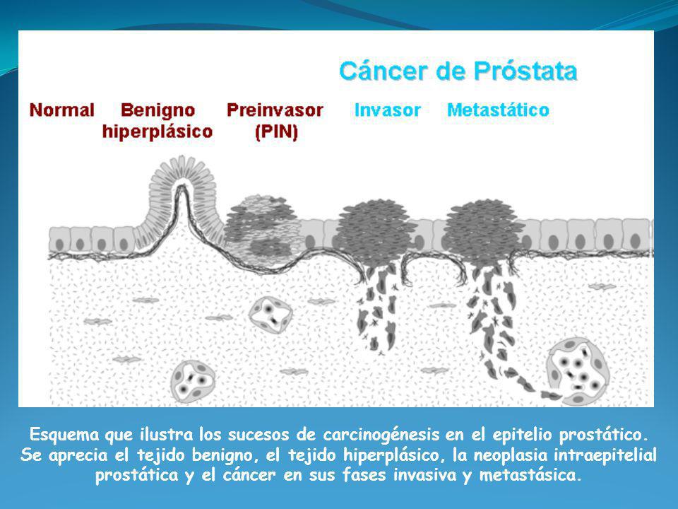 tejido benigno de próstata